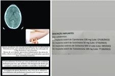 chip-da-beleza:-anvisa-suspende-manipulacao,-comercializacao,-propaganda-e-uso-de-implantes-hormonais-manipulados